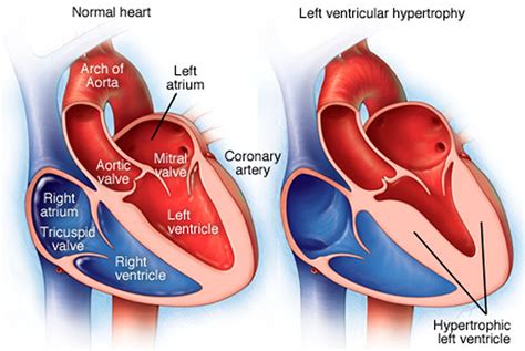 lv wall contraction|Left ventricular hypertrophy .